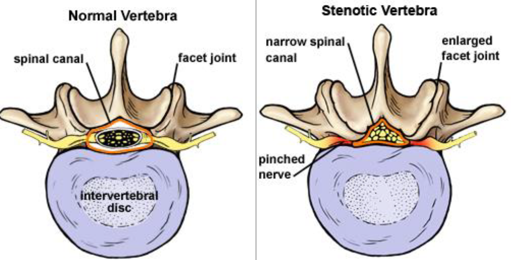 Laminotomy Laminectomy Illustration