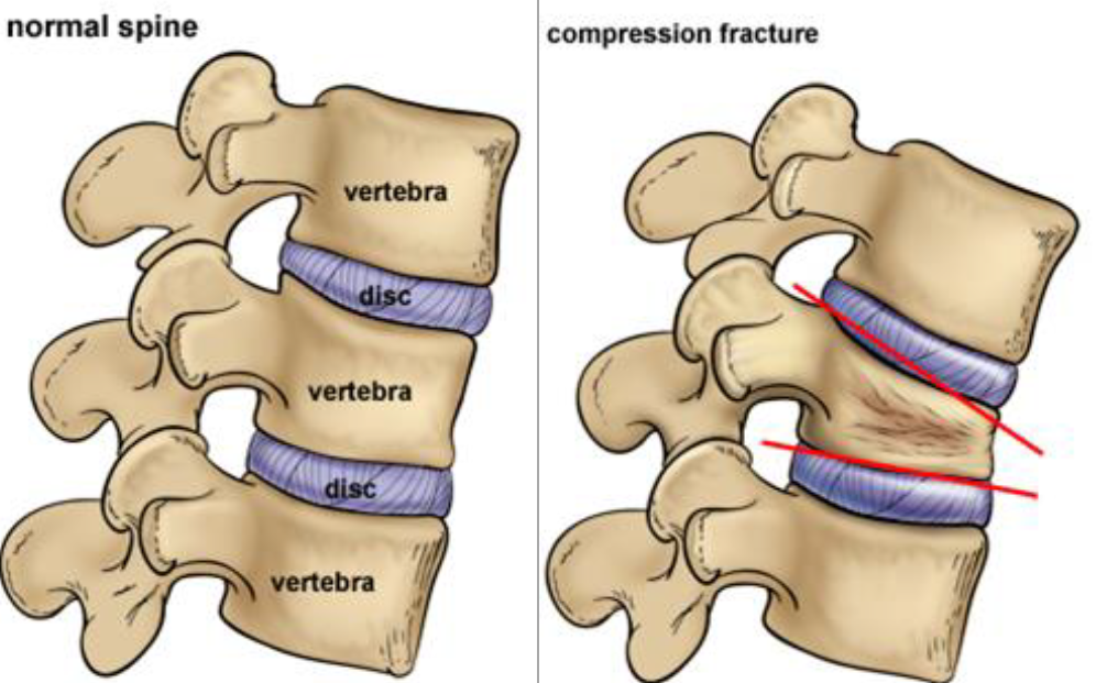 Compression fractures of the back Information