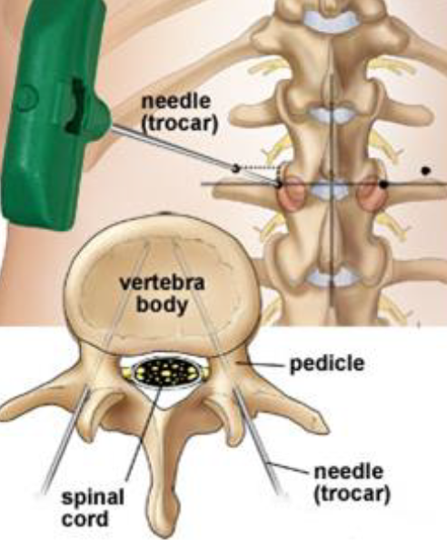 Kyphoplasty Illustration Internal