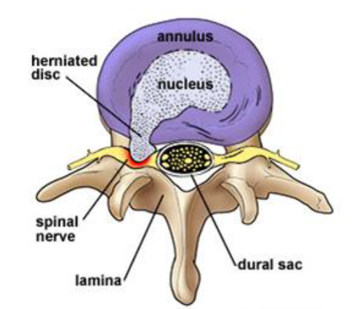 Discectomy Graphic Herniated Disc