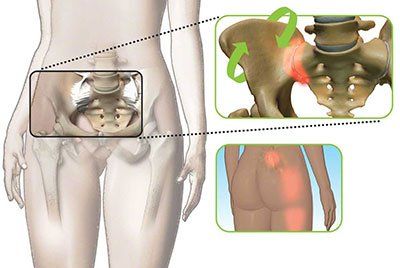 Sacroiliac Joint Pain Graphic Illustration Sacroiliac Joint Pain Graphic Illustration