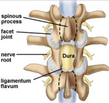 Spinal Cord Stimulator, Merced, CA