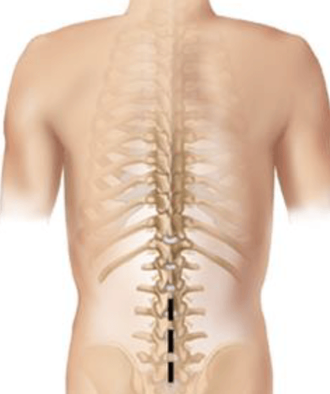 Laminotomy Laminectomy Illustration