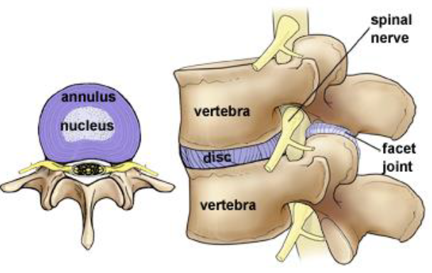 TLIF Graphic Photo of Spine