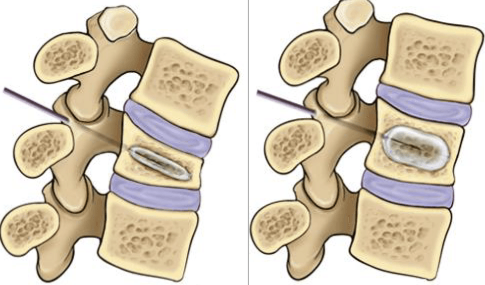 kyphoplasty illustration internal