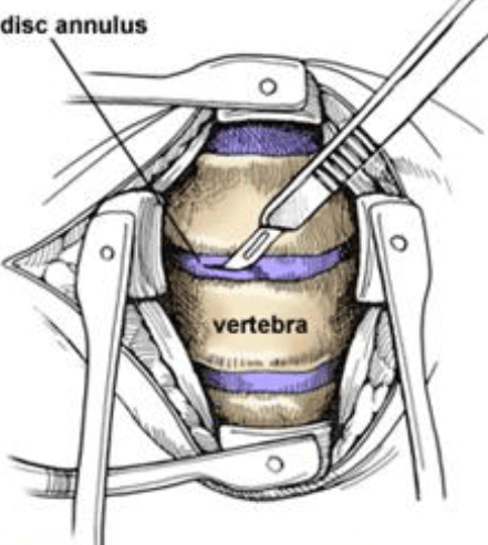 ACDF Image 1 Interior