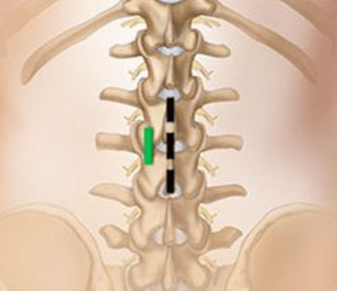 Discectomy Graphic Spinal Column Discectomy Graphic Spinal Column