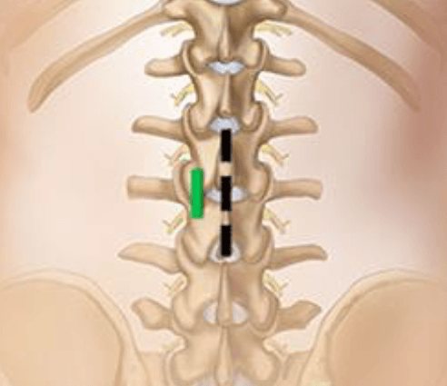Discectomy Graphic Spinal Column