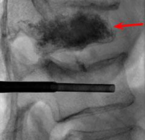 Kyphoplasty x ray 2