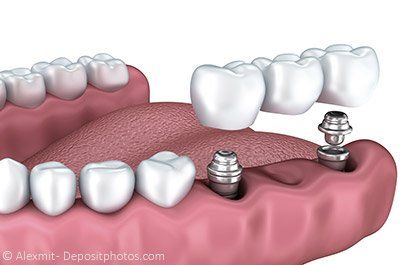 Eine Zahnbrücke kann mit Implantaten befestigt werden