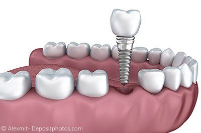 Eine Einzelzahnlücke kann mit einem Zahnimplantat geschlossen werden