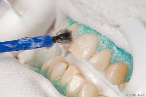 Bleaching beim Zahnarzt - Auftragen des Bleaching-Gels