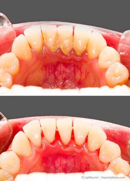 Professionelle Zahnreinigung - Entfernung des Zahnsteines