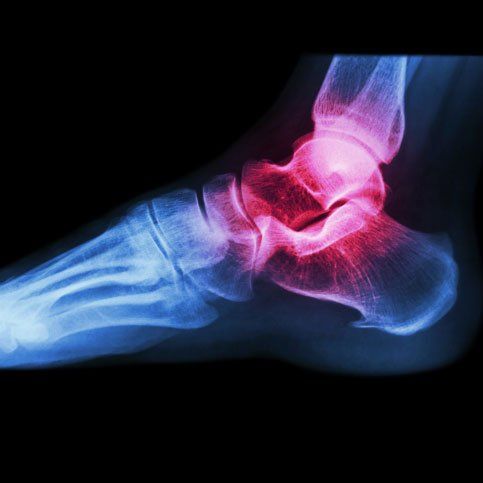 Ankle's X-ray - Foot Injuries in Tuskegee, AL