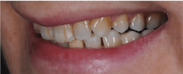 Carillas Dentales, Laminados ó Veneers. ¿Qué son? - Kemm Clinic