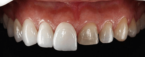 Qué son carillas dentales? precio y tratamiento -canalSALUD