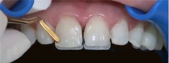 Carillas Dentales, Laminados ó Veneers. ¿Qué son? - Kemm Clinic