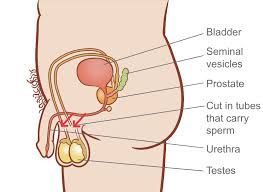 Vasectomy Chart — Endoscopist & General Surgeon in Mackay, QLD
