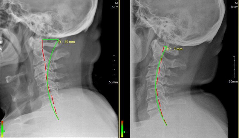 spine/neck x-ray