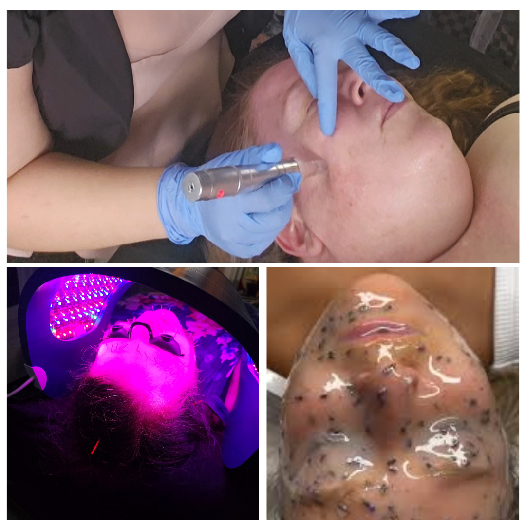 Collage of Facial Microneedling: micro-needling, LED light therapy, and hydrojelly facial mask application.