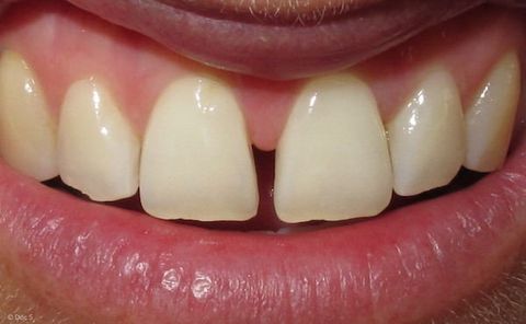 Diastema: Lücke zwischen den Schneidezähnen