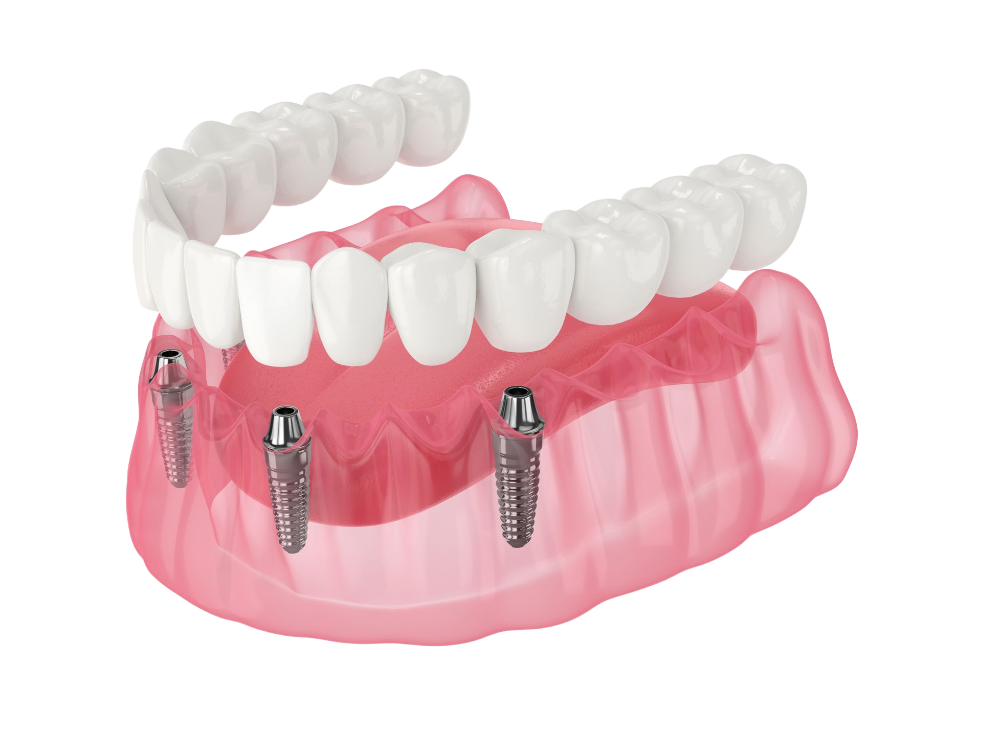 Dental illustration of an upper arch with implants supporting teeth