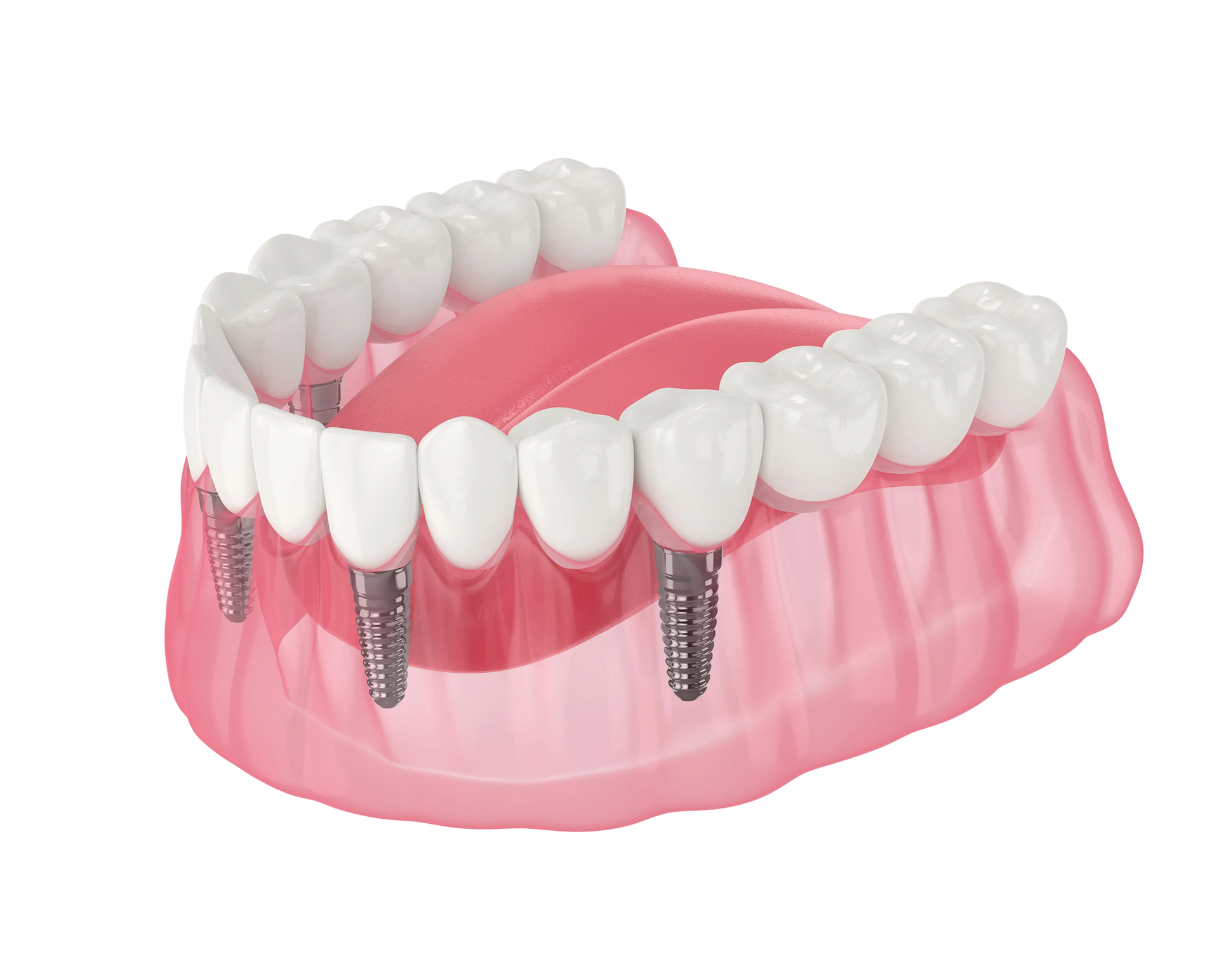 Dental illustration of an upper arch with implants supporting teeth
