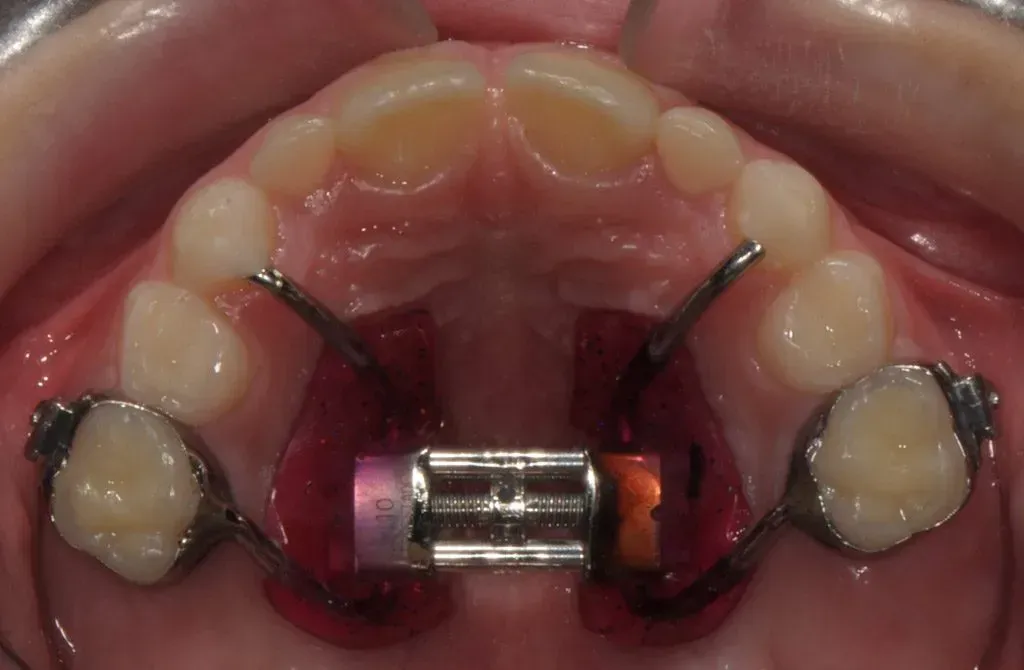Vista dall'alto dei denti con un apparecchio ortodontico rosso e componenti metallici dell'apparecchio sul palato.