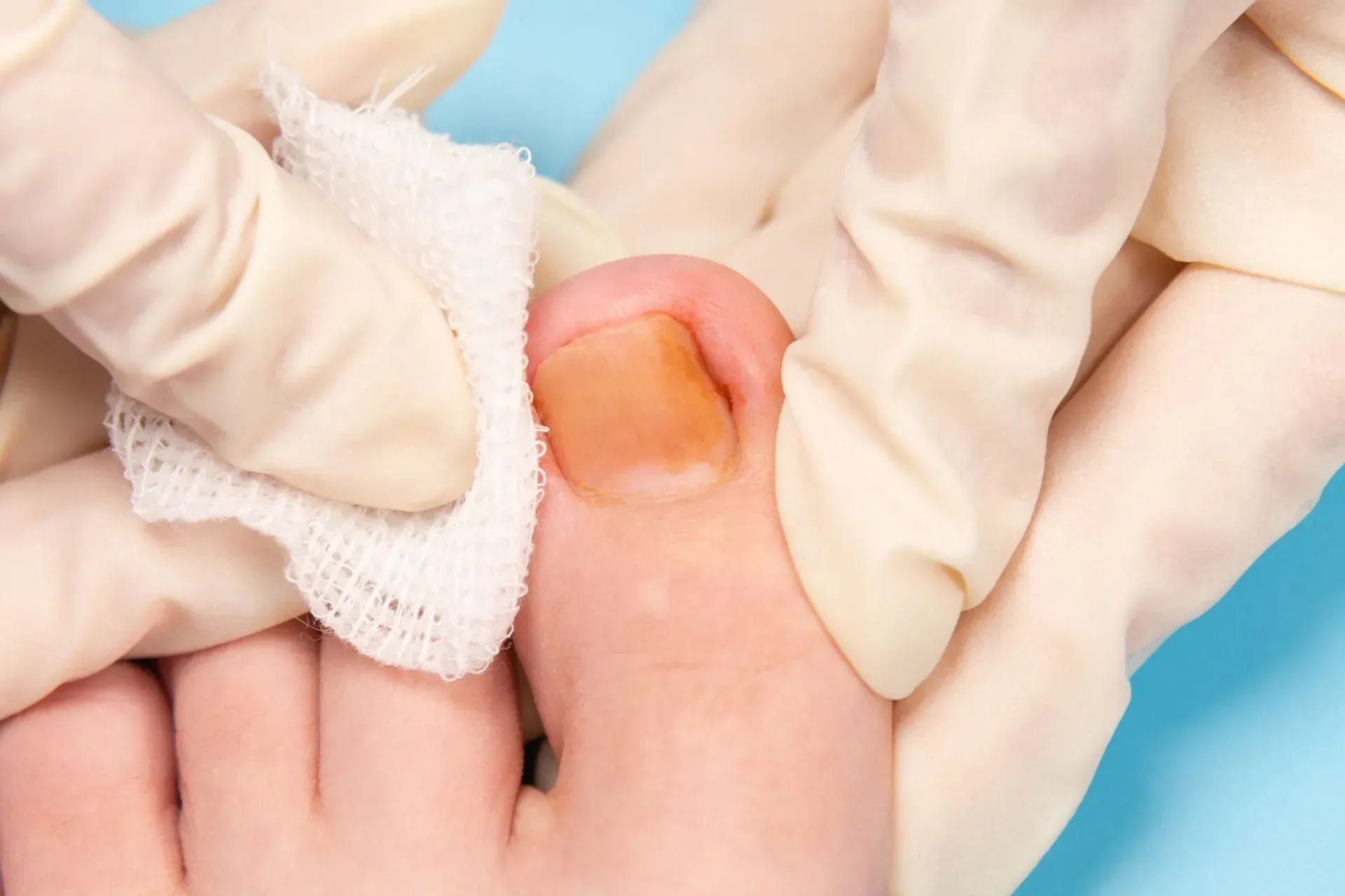 Gloved hands cleaning an infected toenail with a gauze pad against a blue background.