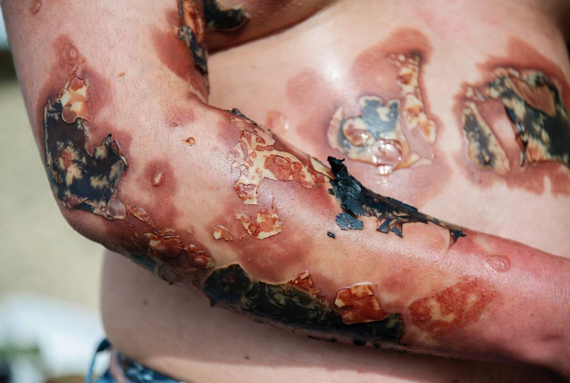 Camouflage van verbrande huid met airbrush make‑up bij een overledene