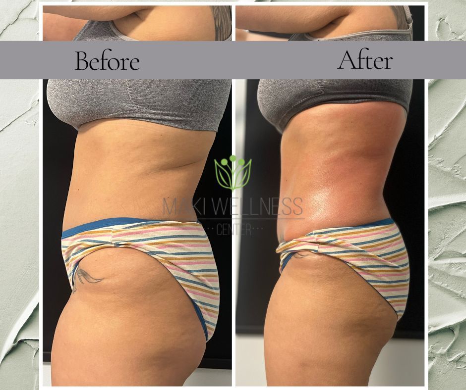 Before and after for cavitation, wood therapy, and lymphatic drainage.
