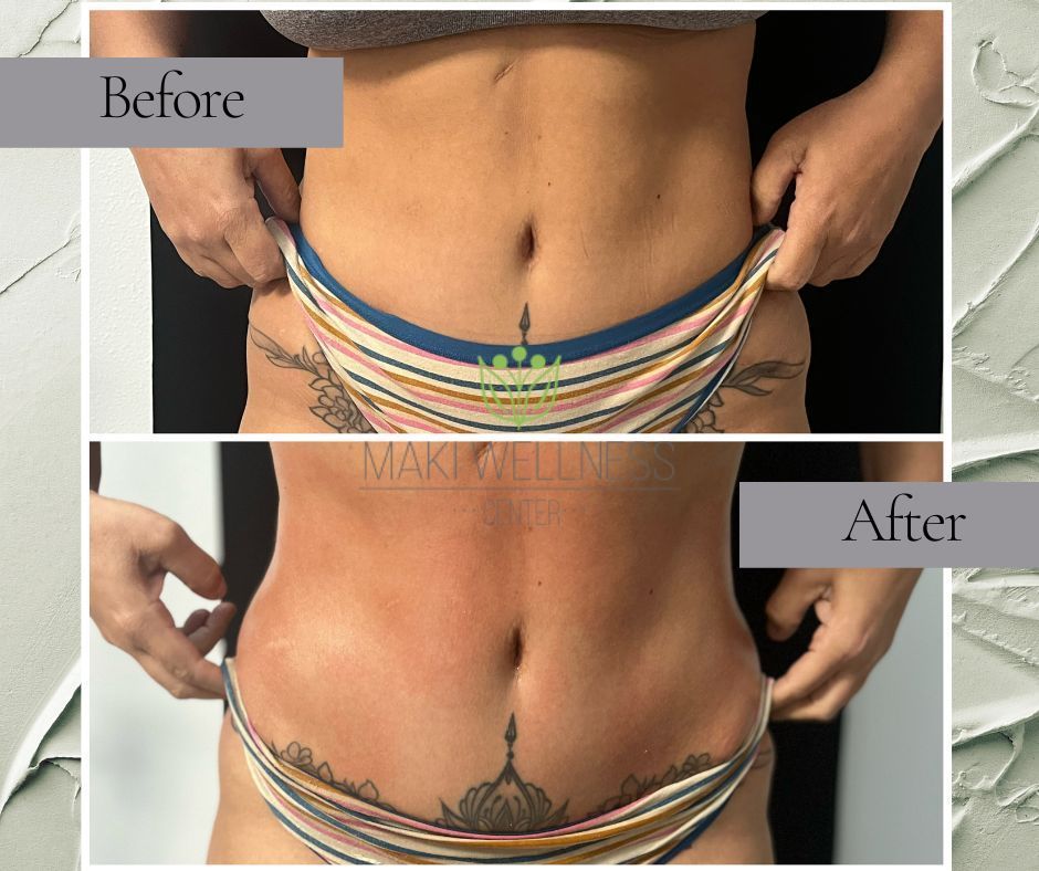Before and after cavitation, wood therapy, and lymphatic drainage