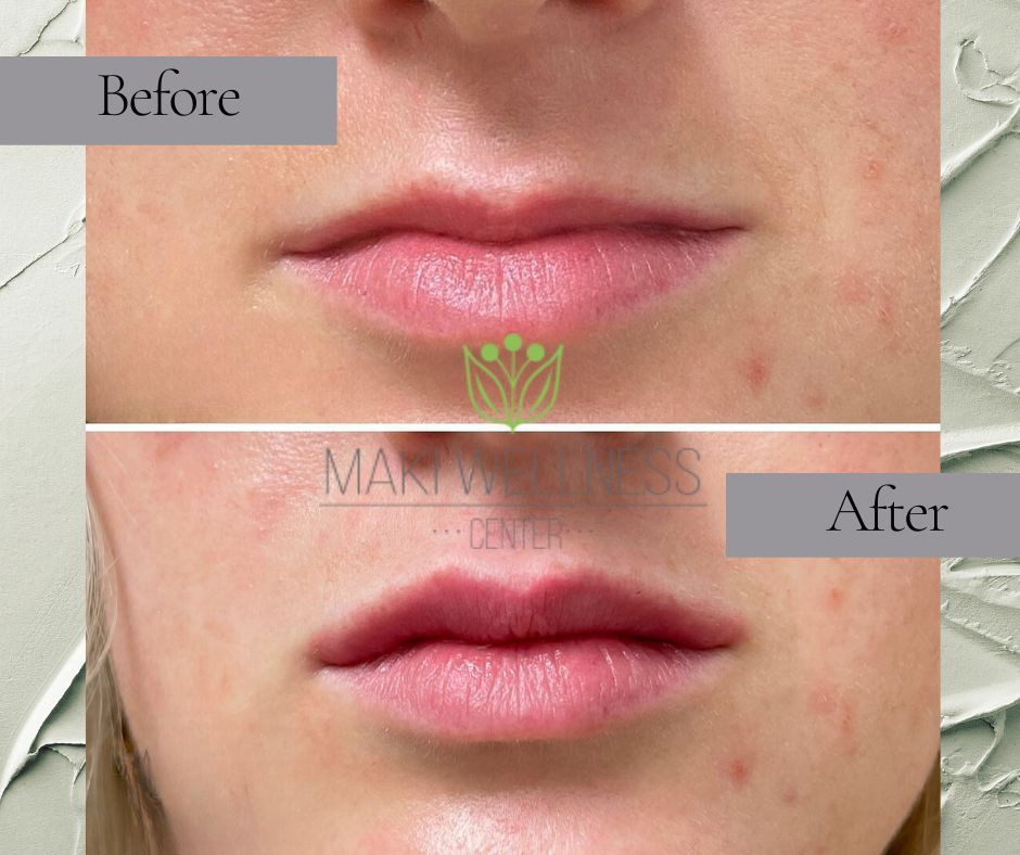 Lip filler treatment before and after