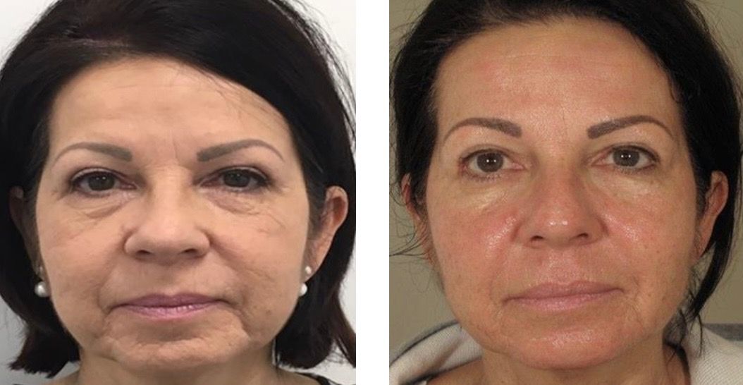 Improving Skin Laxity With Agnes RF Microneedling