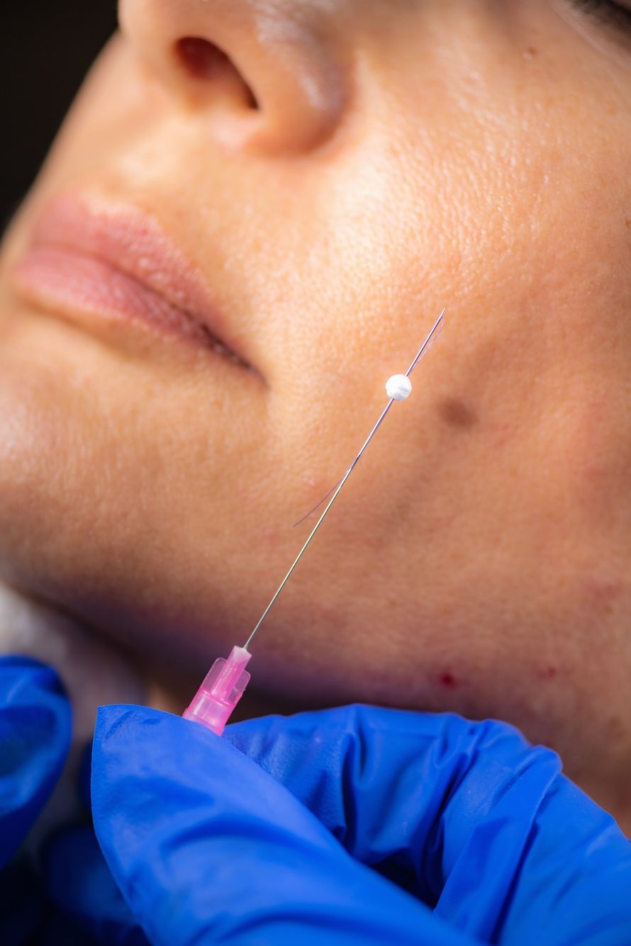 dermal filler treatments Oviedo, fl