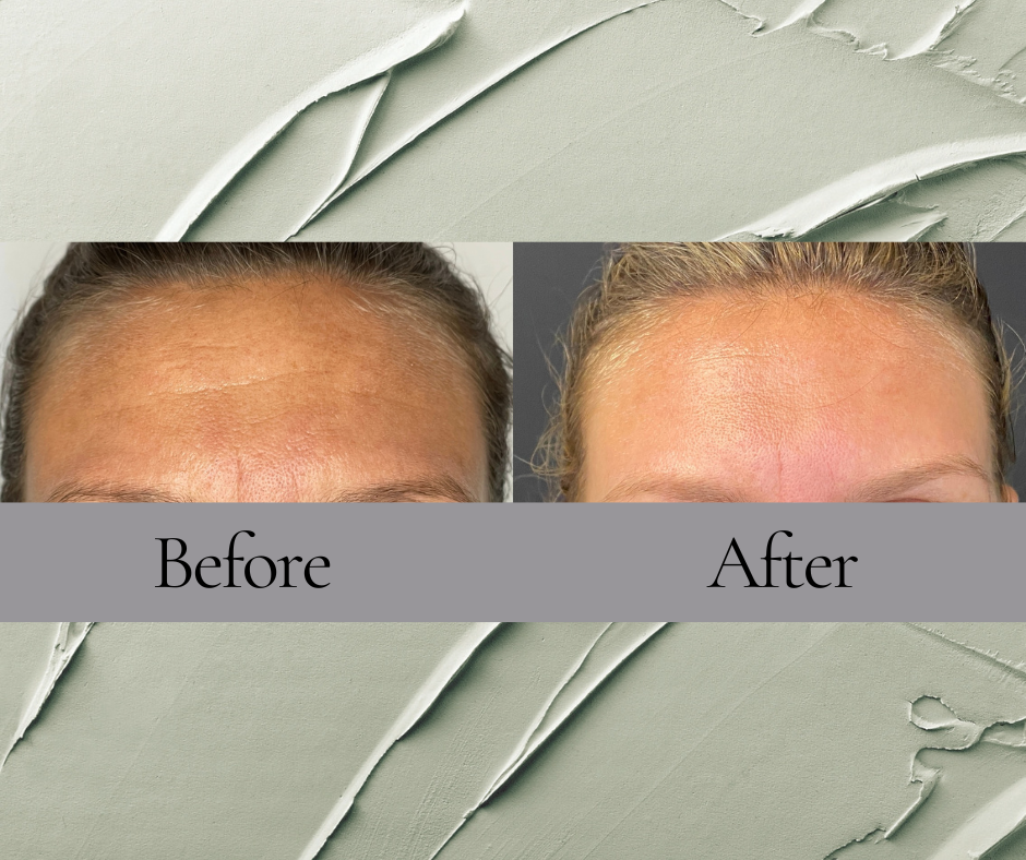 Botox before and After from Maki Wellness