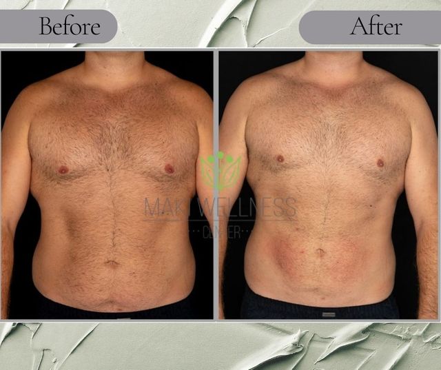 Cryoskin Cryotherapy for Slimming in Harker Heights, TX