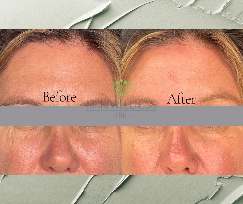 dermal fillers before and after