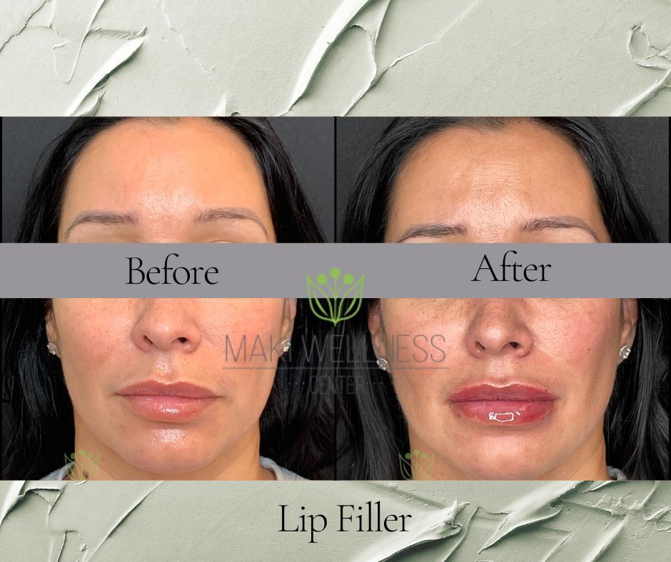 dermal fillers before and after