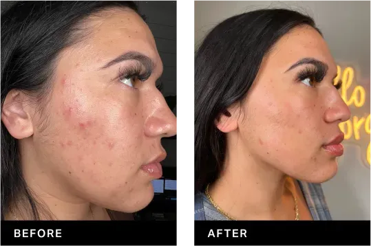 hydrafacial before and after