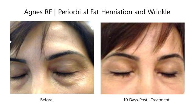 Agnes RF Microneedling Maki Medspa Wellness