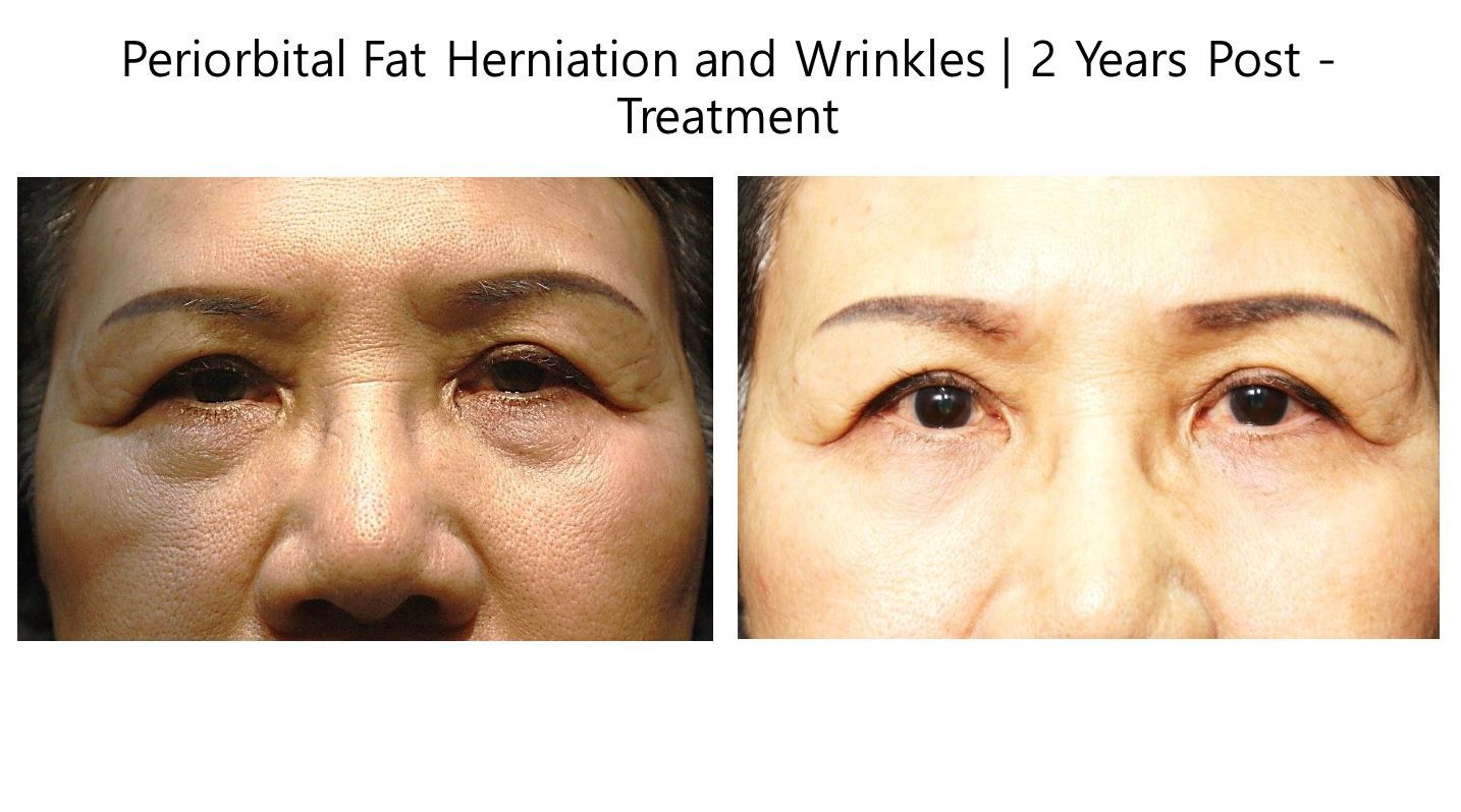 Before and After for Wrinkles