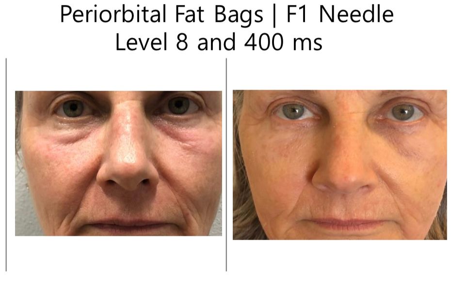 Before and After for Fat Bags