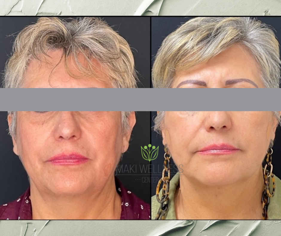 PDO Threading NonSurgical Facelift Maki Wellness Center