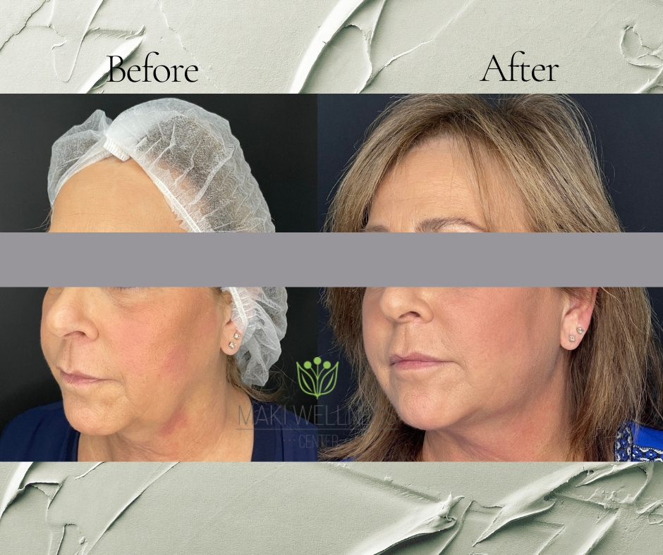 PDO Threading NonSurgical Facelift Maki Wellness Center