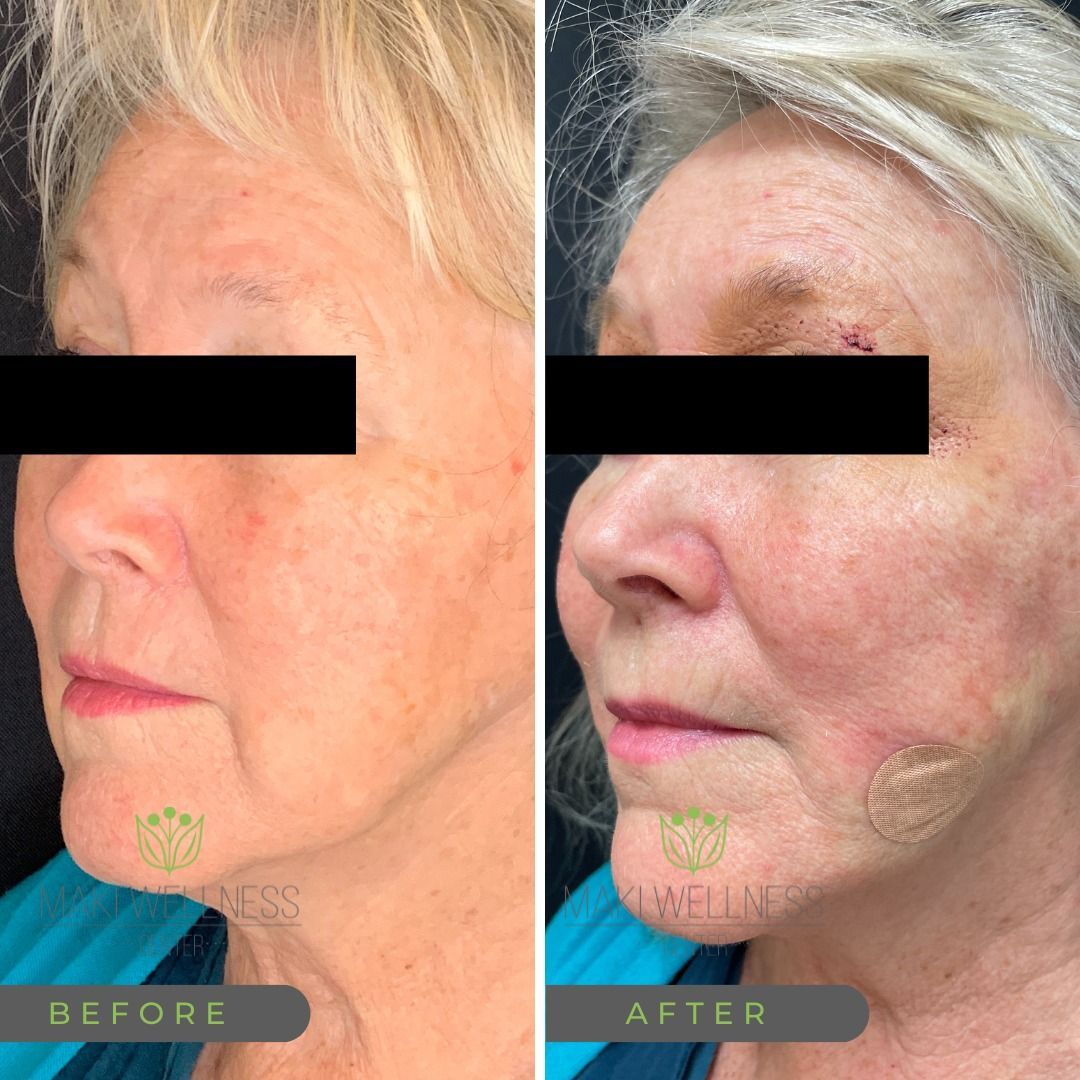 PDO Threading NonSurgical Facelift Maki Wellness Center