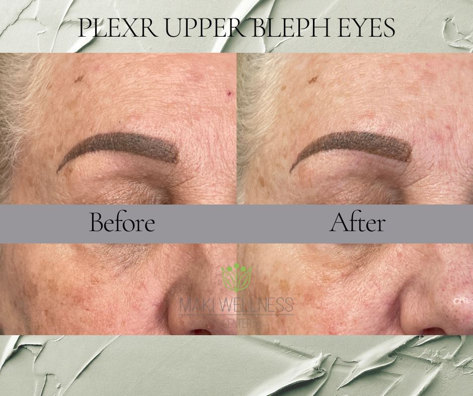 PLEXR BEFORE AND AFTER