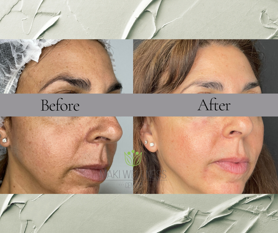 Patient Used A Combination of Chemical Peels & Hydroquinone Cream