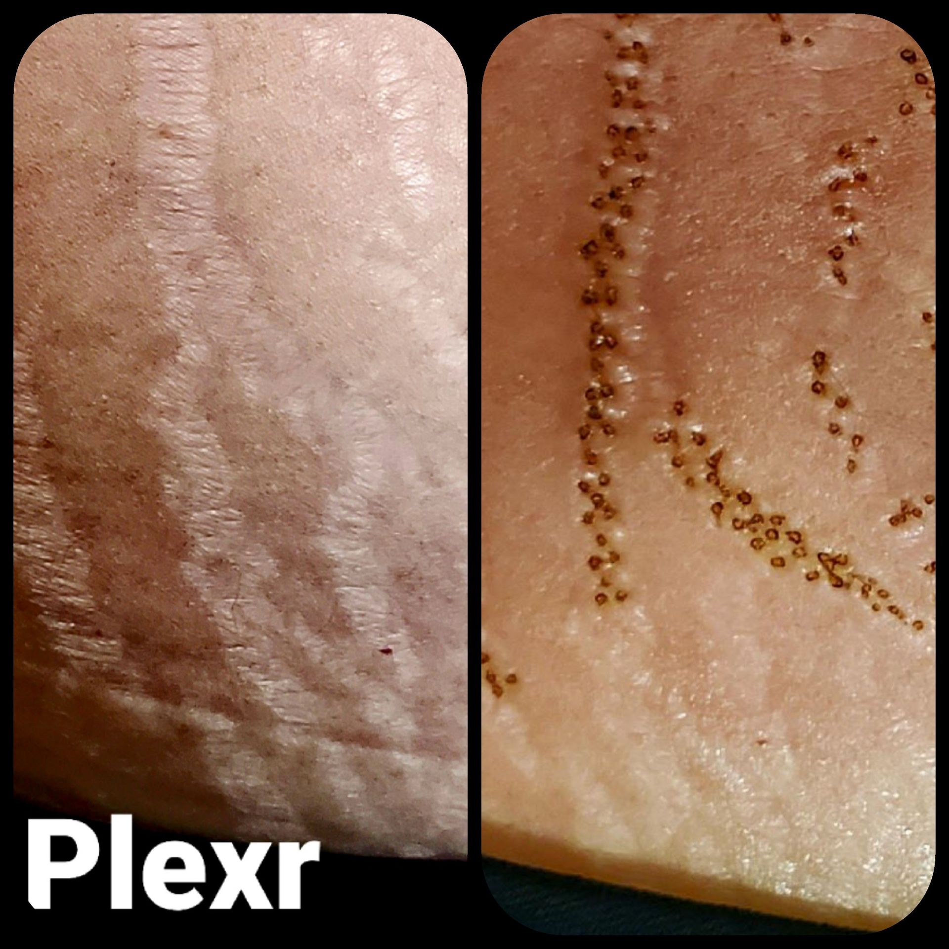 PLEXR BEFORE AND AFTER