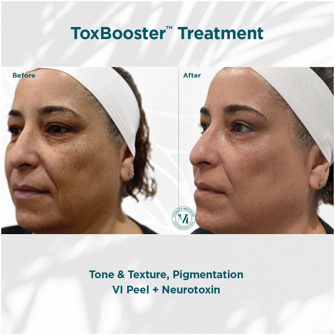 VI CHEMICAL PEELS BEFORE AND AFTER